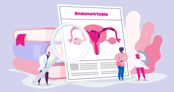 intimina endometrioza