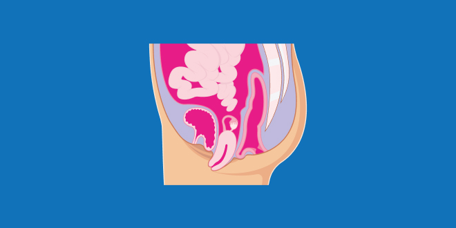 PR_Lead image_Pelvic organ prolapse_ver 1_1