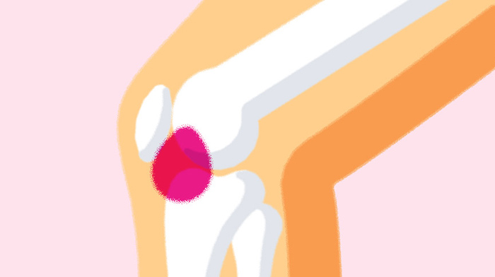 osteoporoza