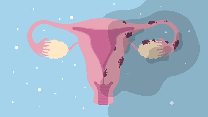 endometrioza i adenomioza