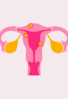 Miomi maternice: zašto se pojavljuju i kako ih liječiti