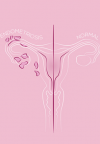 Mjesec osviještenosti o endometriozi: Zašto žene čekaju 8 godina na dijagnozu