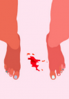 Točkasto krvarenje između menstruacija