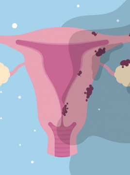 Endometrioza i adenomioza – kad bolna menstruacija postane ozbiljan problem
