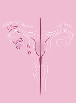 Mjesec osviještenosti o endometriozi: Zašto žene čekaju 8 godina na dijagnozu
