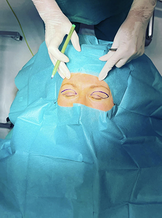 Sve što trebate znati o podizanju očnih kapaka